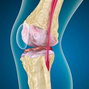 Excessive tension in the thigh muscle causes pain in the knee