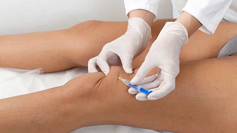 Intra-articular injection for knee osteoarthritis