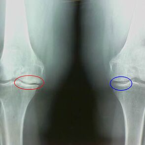Osteoarthritis of the knee joint on radiography