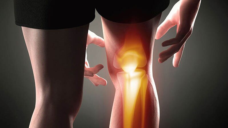 Osteoarthritis of the knee joint